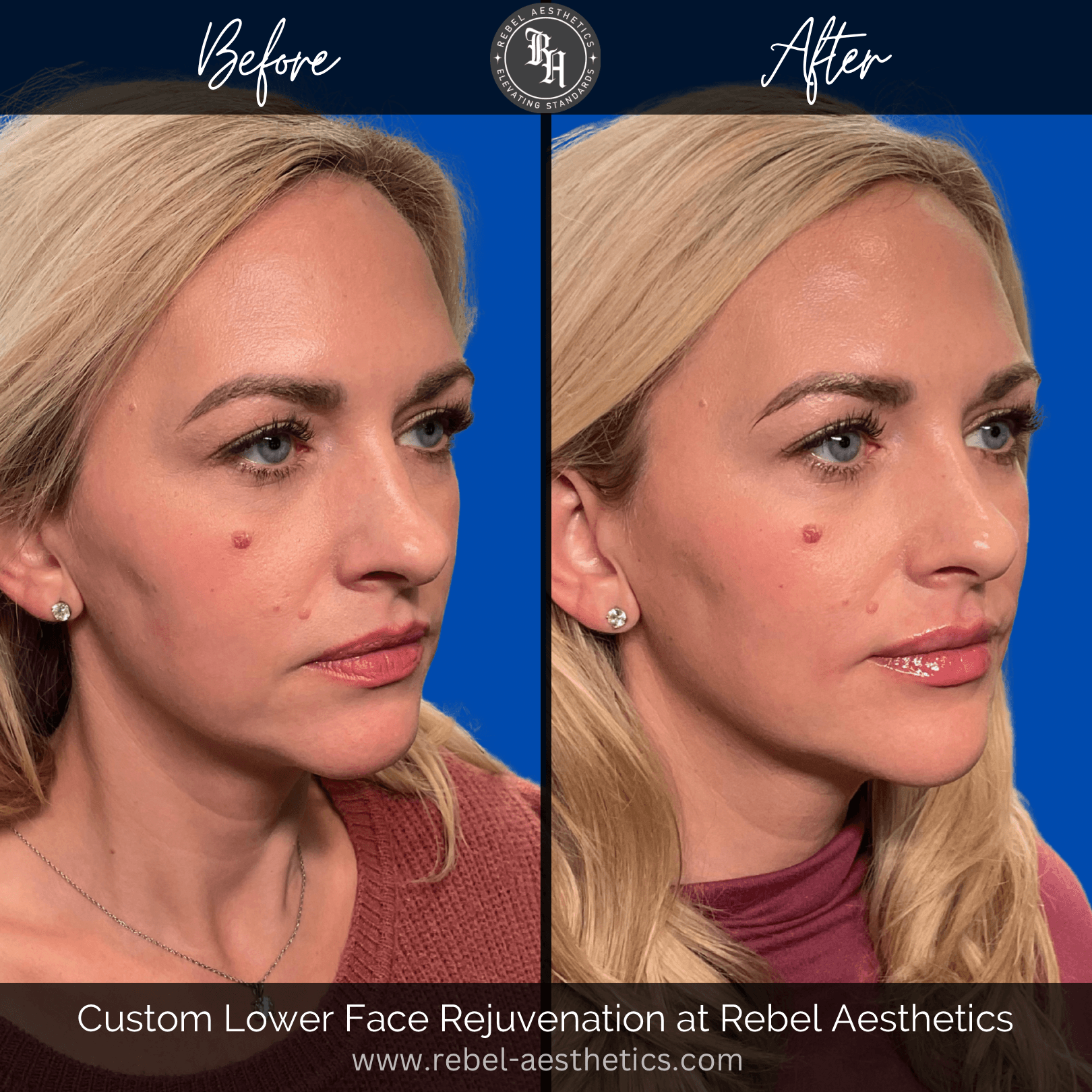 Facial Balancing and Botox treatment for female patient at Rebel Aesthetics including dermal filler injections for the lips, oral commissures, marionette lines, chin, and jawline