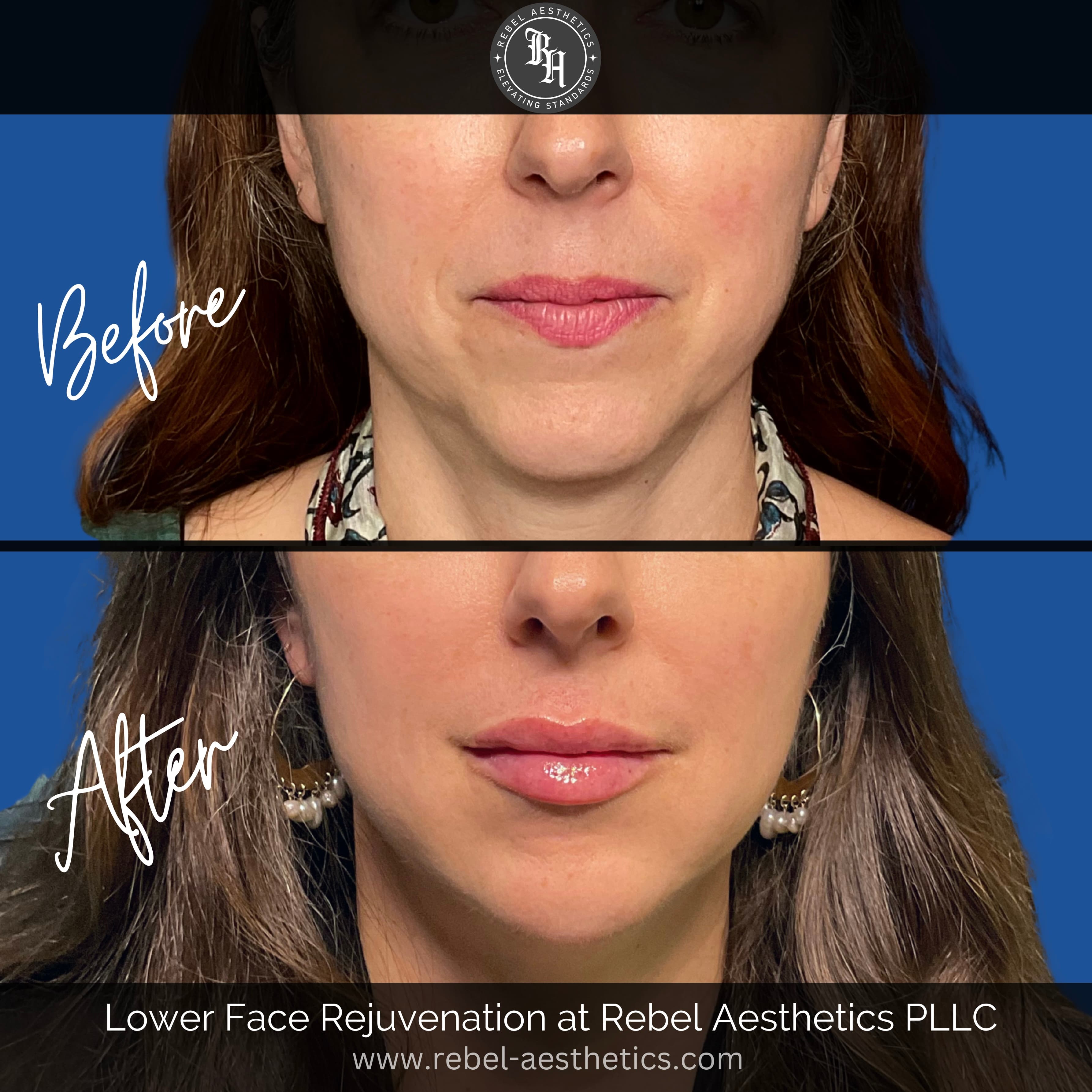 Female patient who has had dermal filler injections for nasolabial folds, lips, mouth corners, marionette lines, chin and jawline