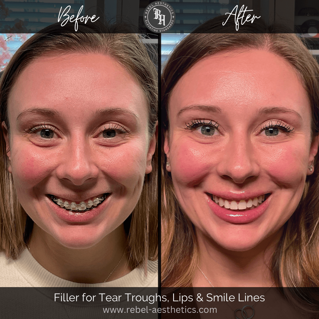 Facial Balancing treatment for female patient at Rebel Aesthetics including dermal filler injections for the tear troughs, nasolabial folds, and lips