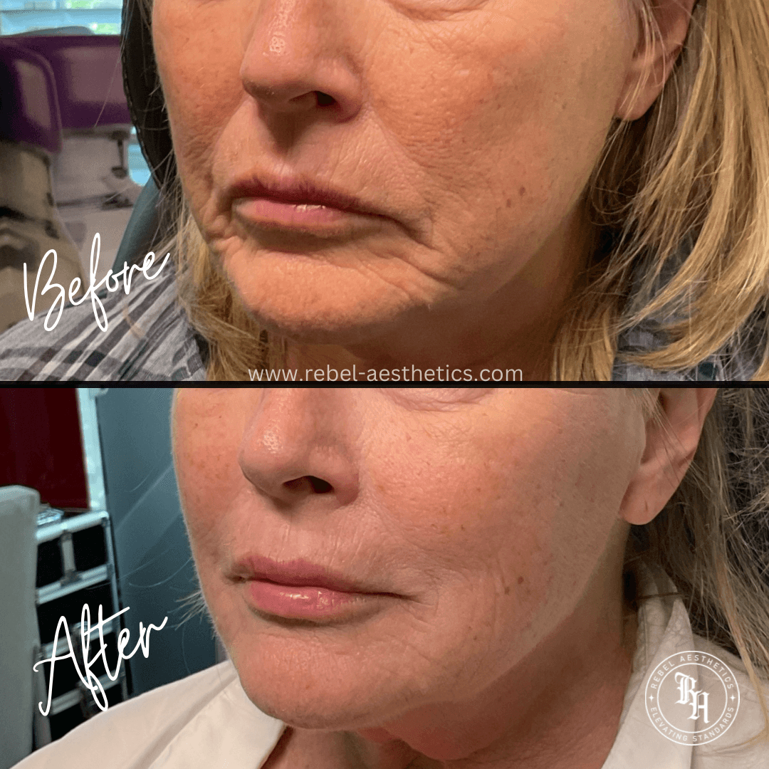 Side by side comparison of a patient who received Filler injections for lips, marionette lines, smile lines, mental crease and expression lines.