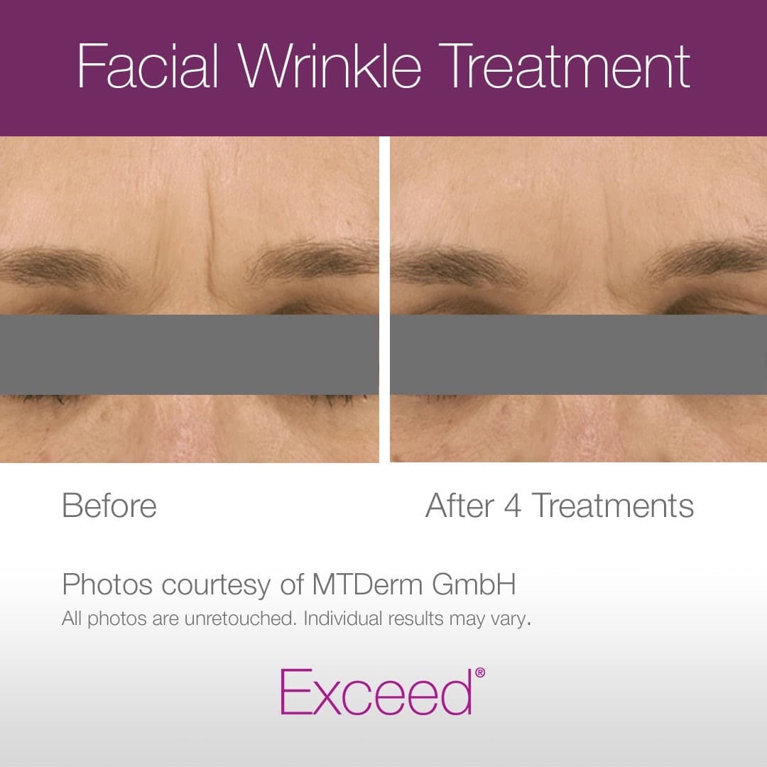 Side by side photos that show Exceed microneedling to be an effective facial wrinkle treatment option for women and men looking for something that actually reduces fine lines and wrinkles on the face. Before and after photos show results from microneedling after 4 treatments to effectively reduce elevens wrinkles