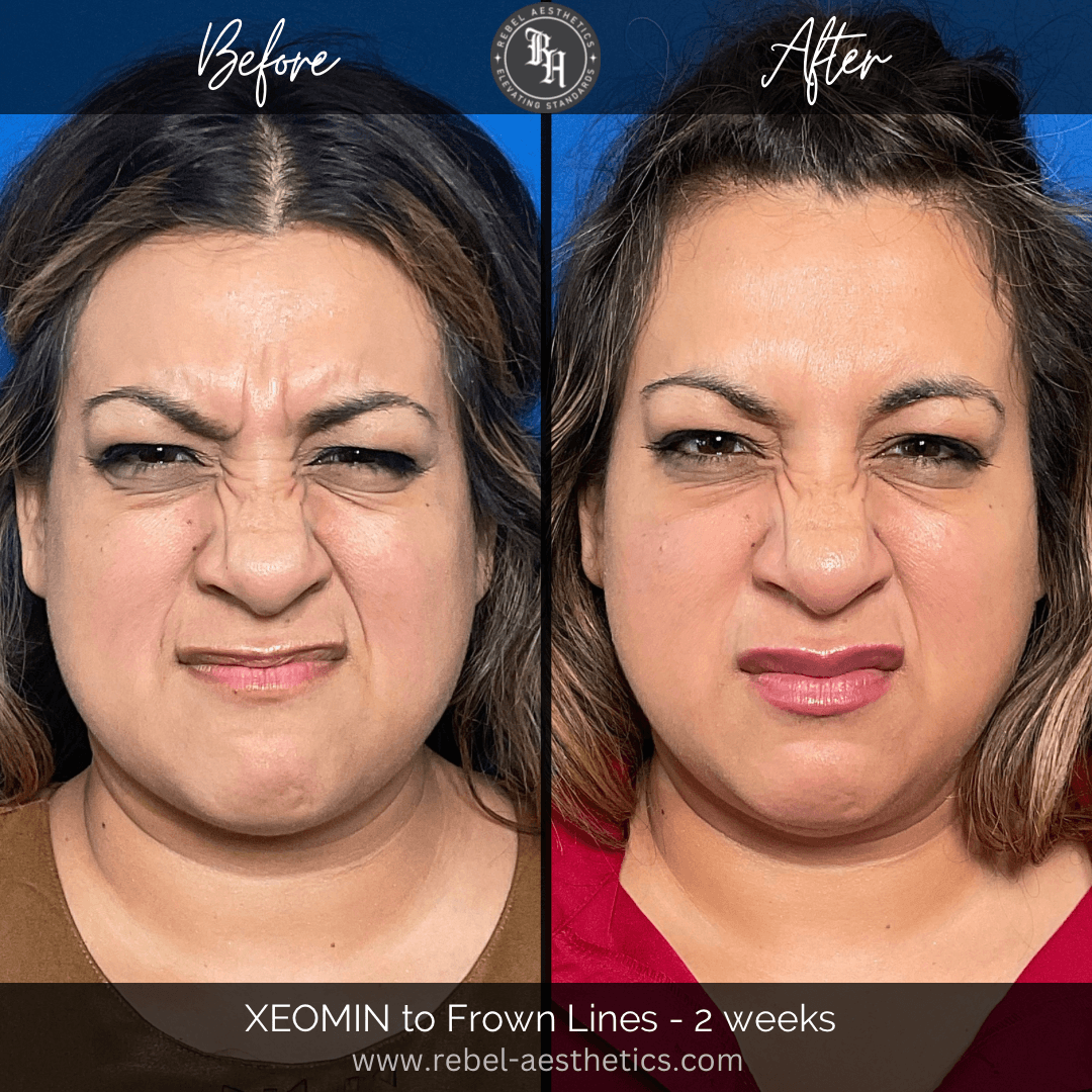 Before & After Tox for frown lines