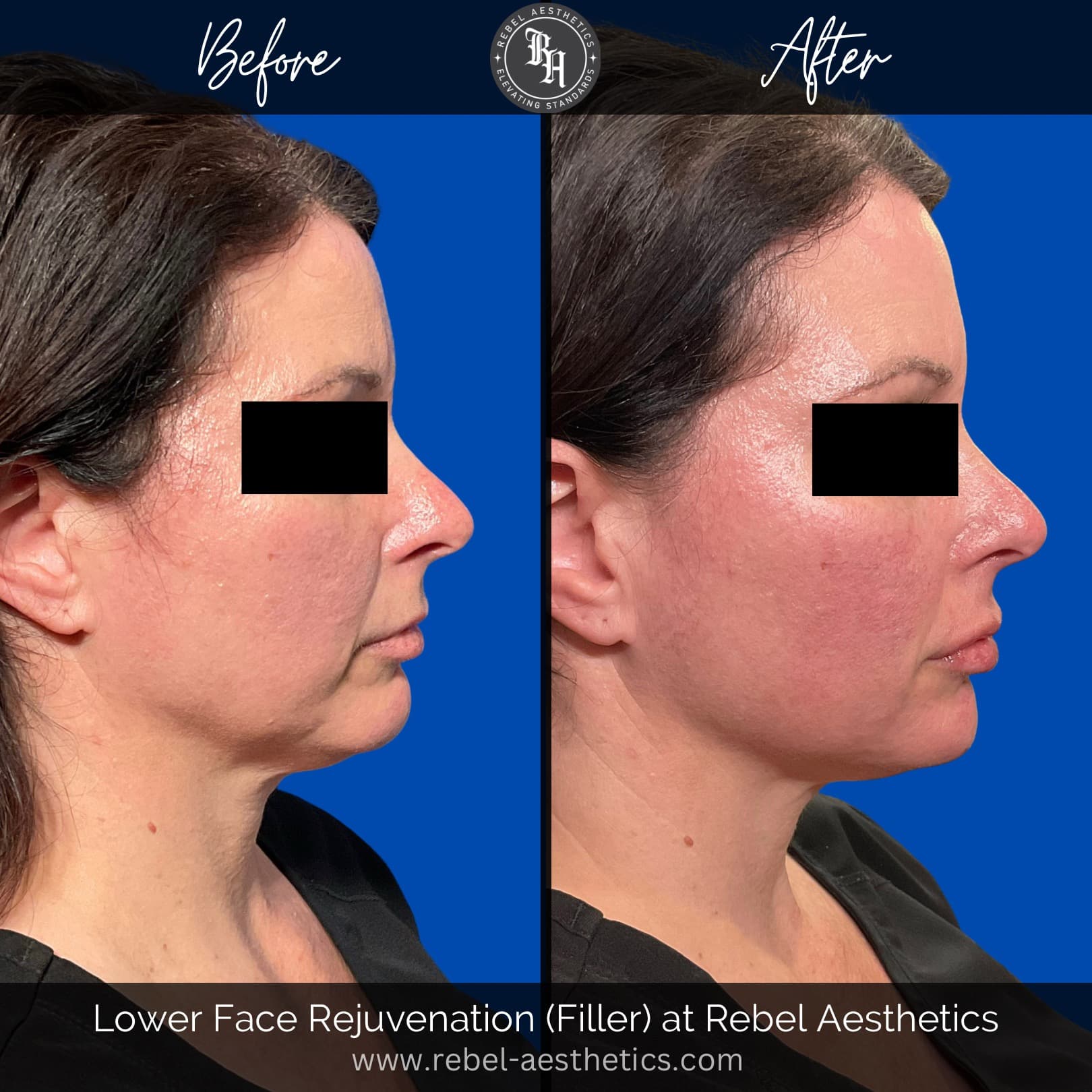 Facial balancing female patient at Rebel Aesthetics who received dermal filler injections for her lips, nasolabial folds, chin and jawline