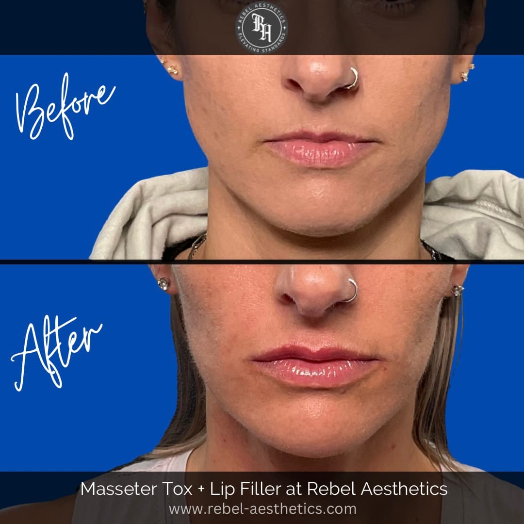 Before & After Tox for Masseters