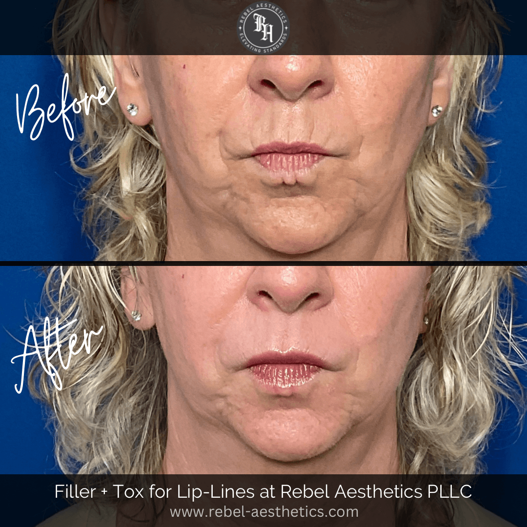 Before & After Tox for lip lines