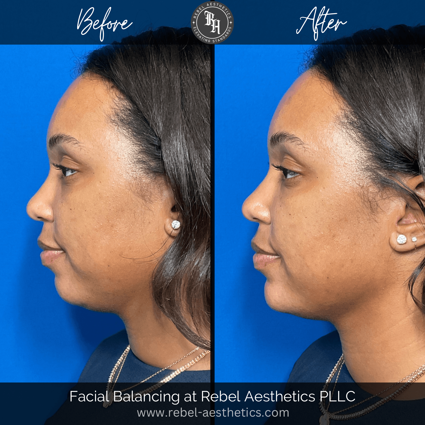 Before & After - Facial Balancing with chin and jawline filler