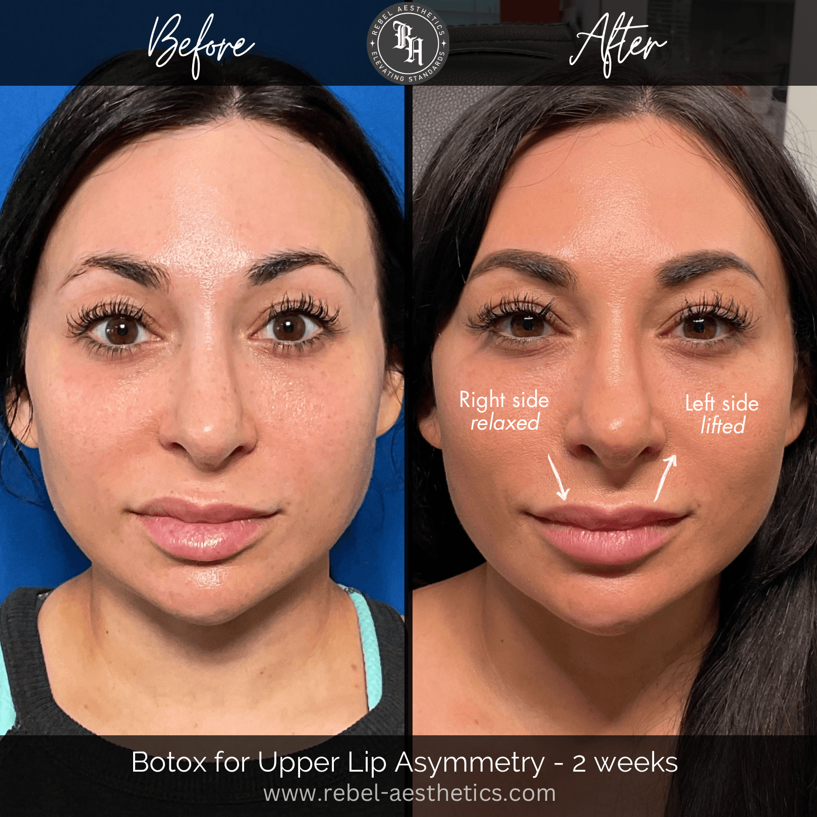 Before & After Tox for Lip Asymmetry