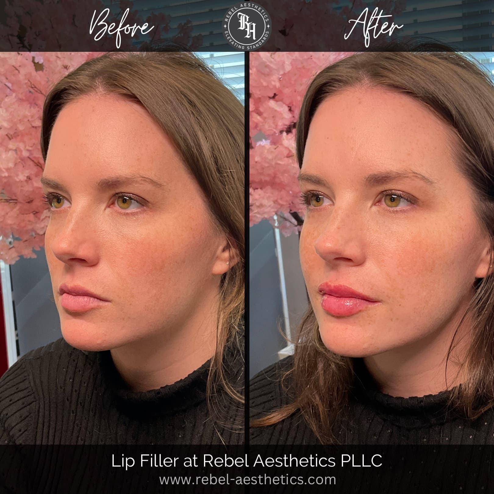Lip filler