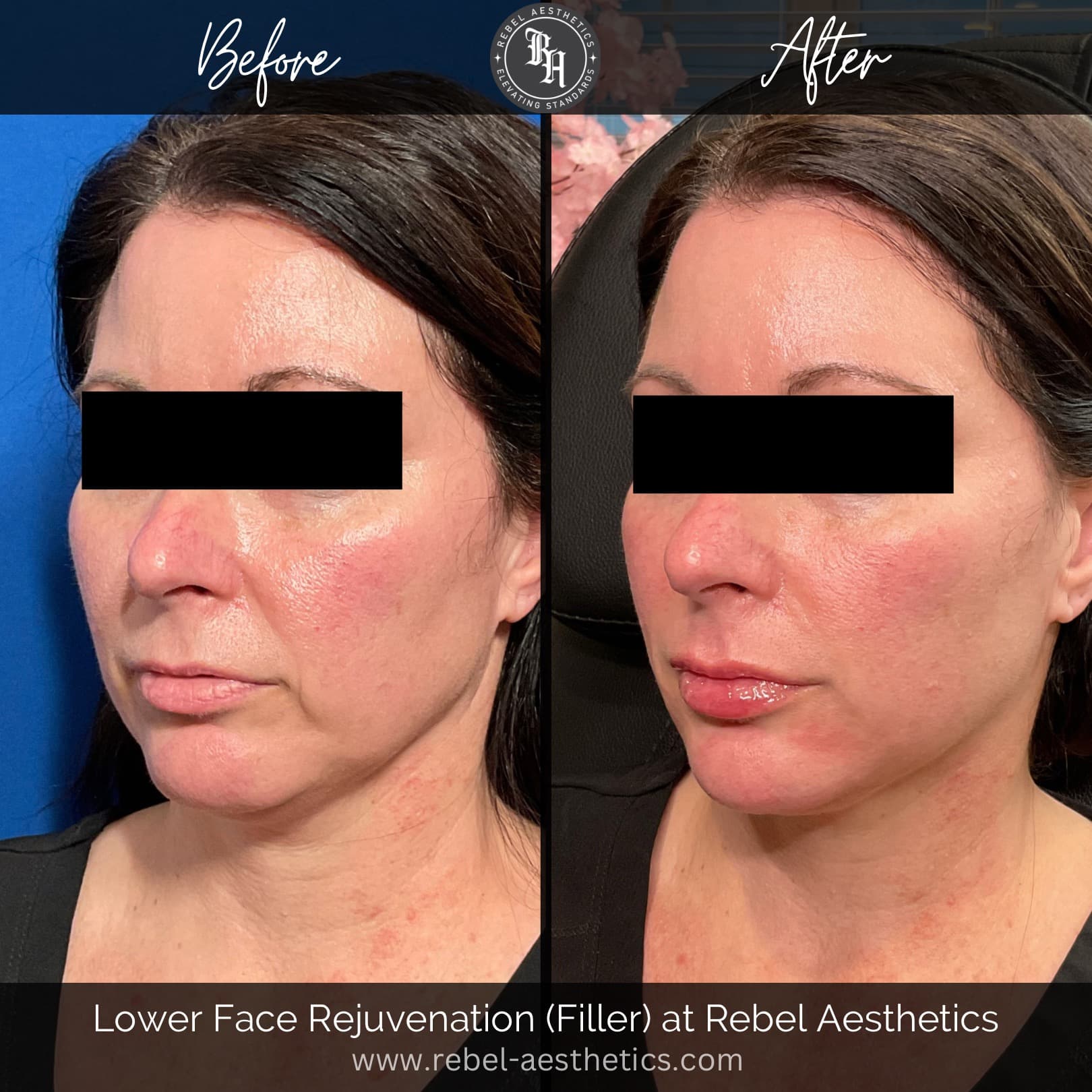 Facial Balancing treatment for female patient at Rebel Aesthetics including dermal filler injections for the nasolabial folds, lips, chin and jawline